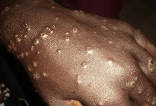 Image d'illustration maladie des pecheurs à Thiaroye